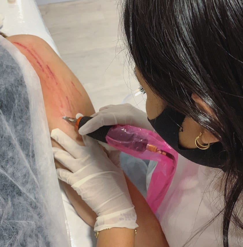 Aplicação do Regenera Derme em estrias