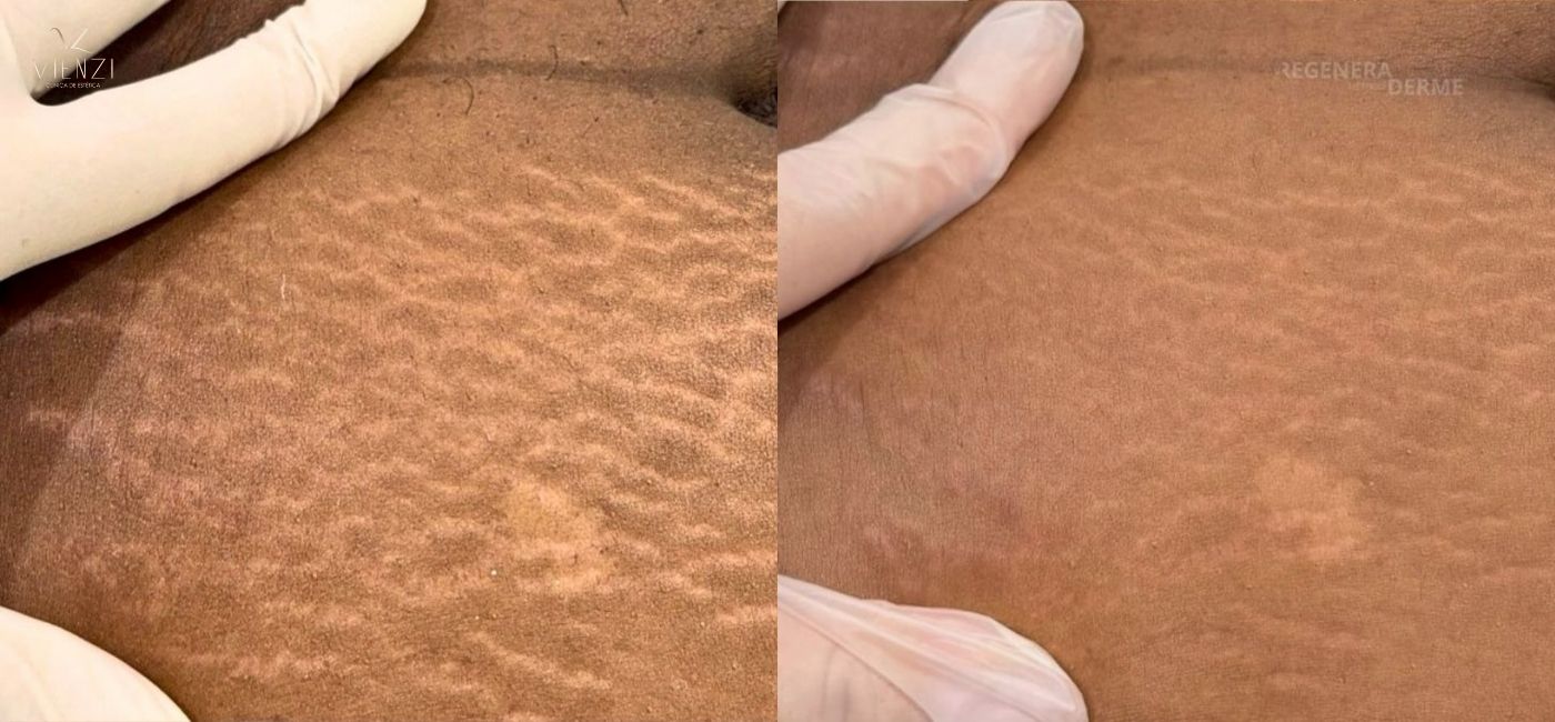 Antes e depois do tratamento 1