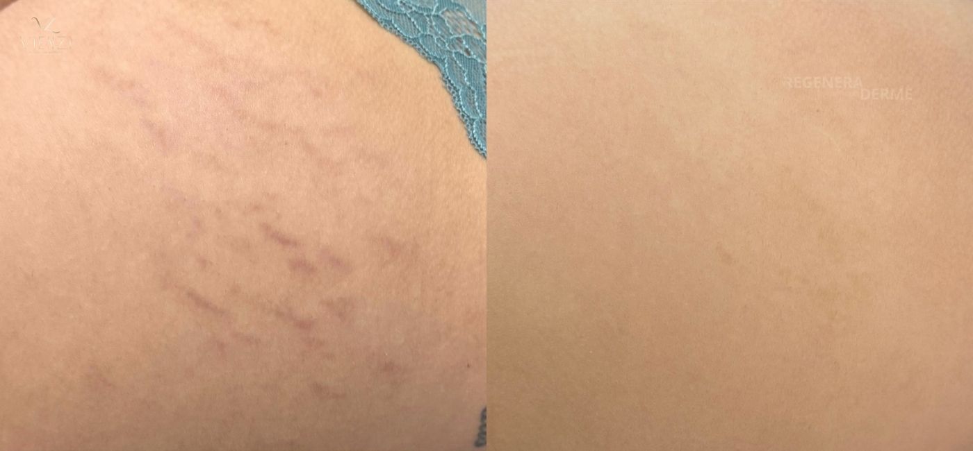 Antes e depois do tratamento 4