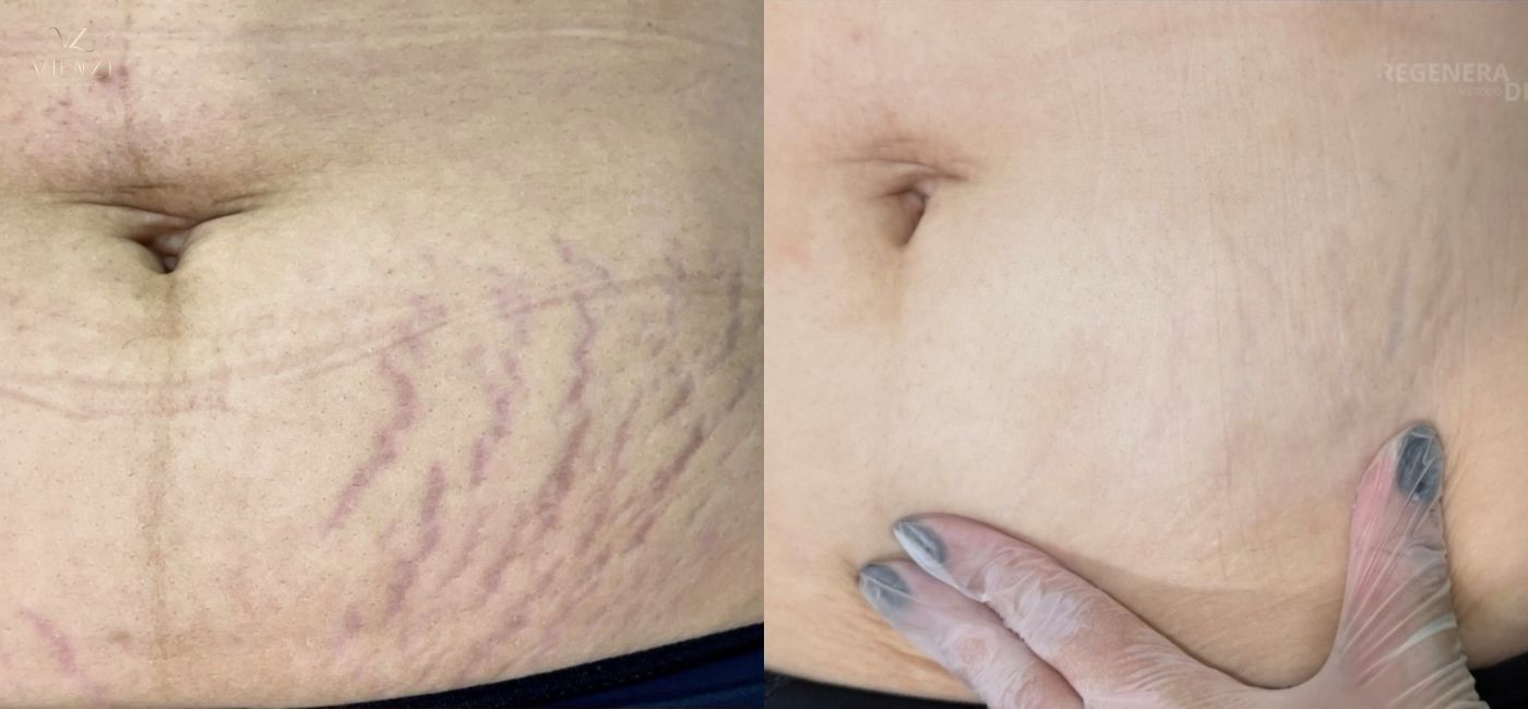 Antes e depois do tratamento 2